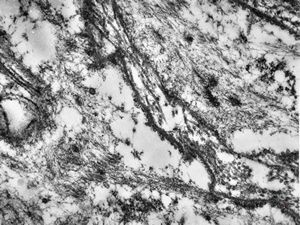 M,10y. | leiomyosarcoma